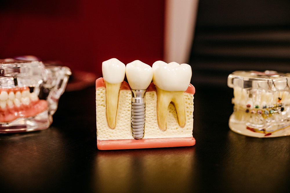 Czym są mosty dentystyczne?