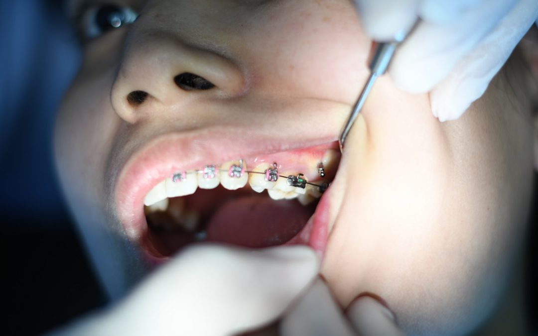 rodzaje apartów na zęby (2)