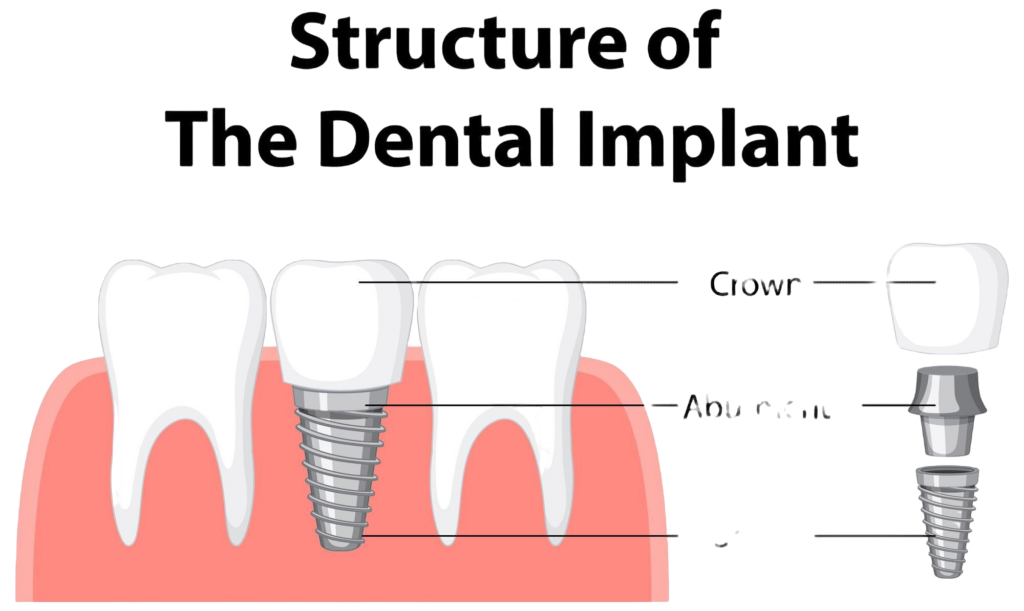czy implant stomatologiczny może zostać odrzucony przez organizm?